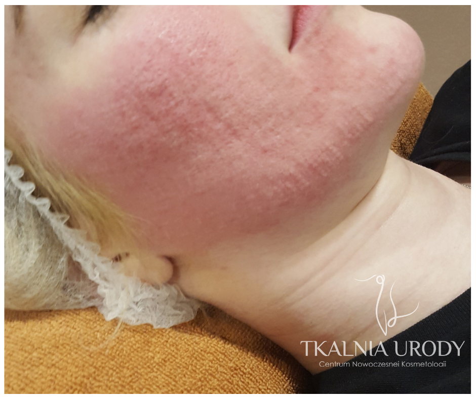 blizny potrądzikowe