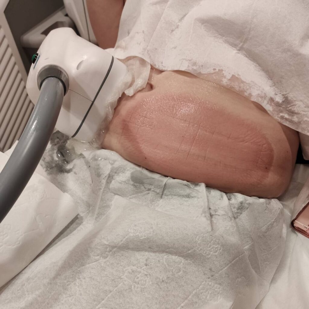 Zabieg kriolipolizy w Bielsku-Białej.