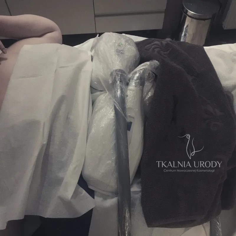 Kriolipoliza w Tkalni Urody w Bielsku-Białej