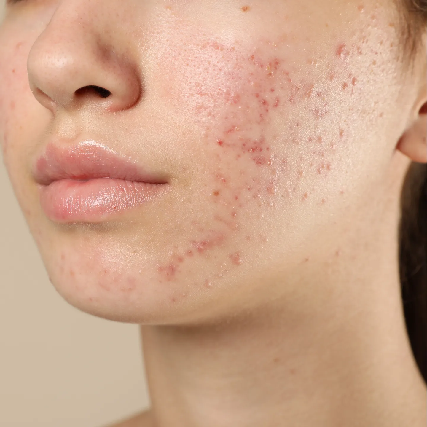 zabiegi gabinetowe na tradzik bielsko